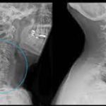 دیسک دژنراتیو گردن چه نوع بیماری است؟