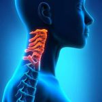 آرتروز گردن چیست؟