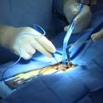 آیا جراحی‌ سیاتیک سریعترین راه برای تسکین درد است؟