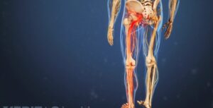 مشکلات در بخش L4-L5 می تواند باعث درد در ناحیه کمر و پاها شود.