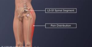 مشکلات در بخش L5-S1 می تواند باعث درد در سرتاسر قسمت پایین بدن شود.